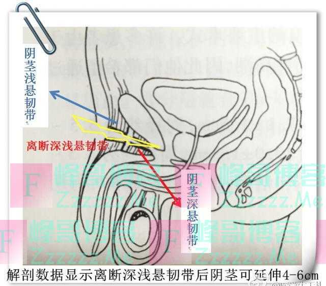 通过大量的尸体解剖和临床实践发现通过离断阴茎深浅悬韧带可以使阴茎