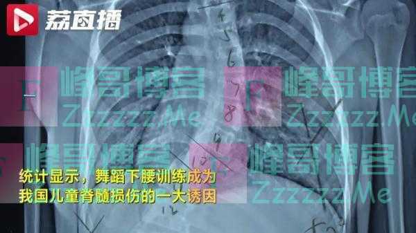 这个动作或致瘫痪！一医院仅3周已接诊5例，医生提醒→