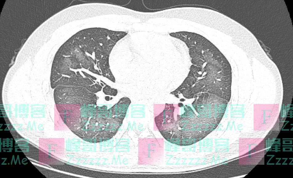 千万别乱对脸！20岁小伙已查出“白肺”！很多明星都在用