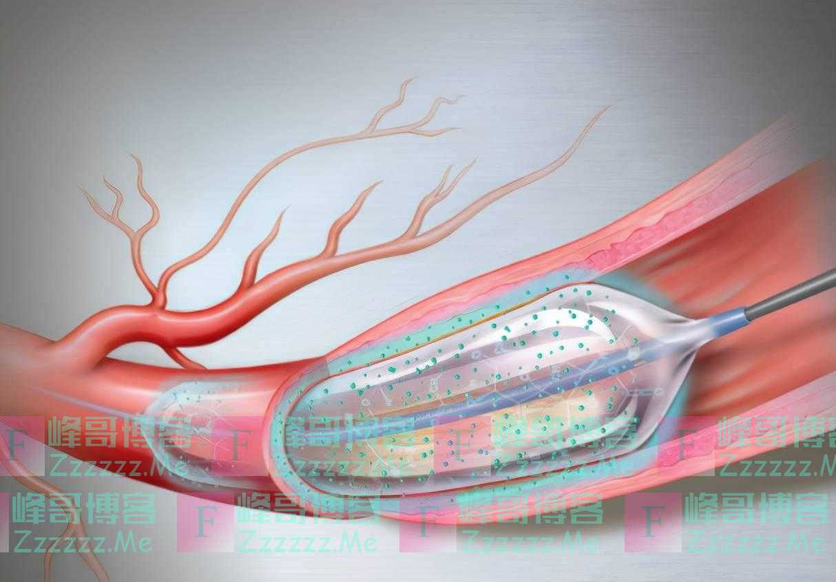 装上心脏支架后，还能活多少年？医生不再隐瞒，建议了解清楚