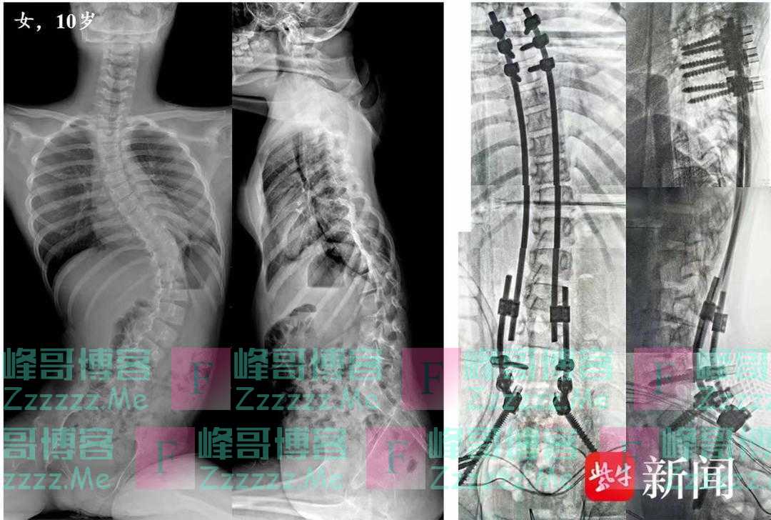 3周接诊5例下腰瘫痪致脊柱畸形！这个动作别掉以轻心