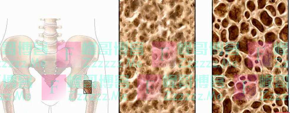 如何预防骨质疏松症？每天这样做，强健骨骼
